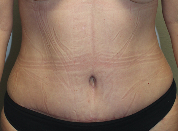 Tummy Tuck (Abdominoplasty)