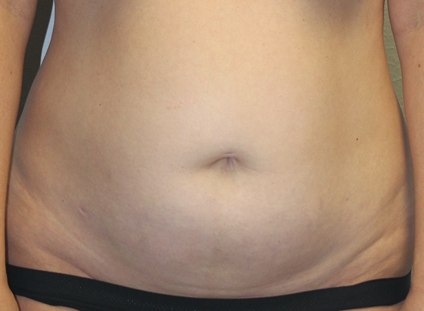 Tummy Tuck (Abdominoplasty)