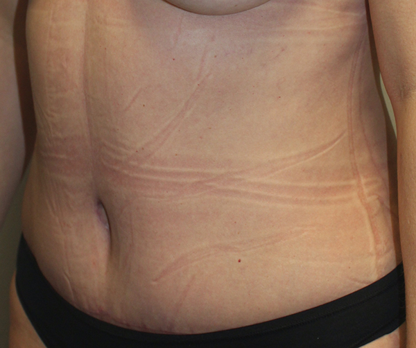 Tummy Tuck (Abdominoplasty)