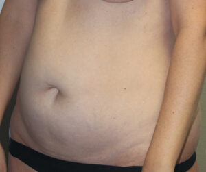 Tummy Tuck (Abdominoplasty)