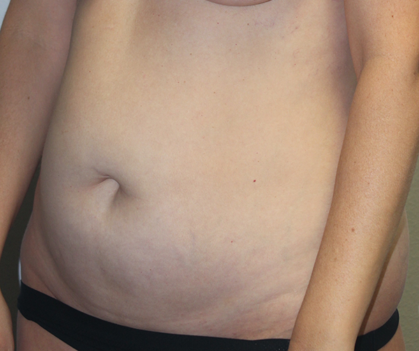 Tummy Tuck (Abdominoplasty)