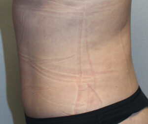 Tummy Tuck (Abdominoplasty)