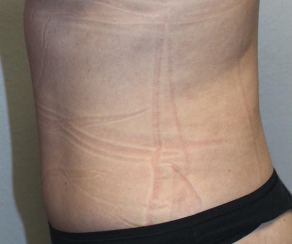 Tummy Tuck (Abdominoplasty)