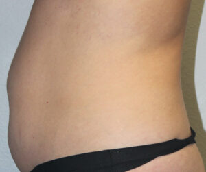 Tummy Tuck (Abdominoplasty)