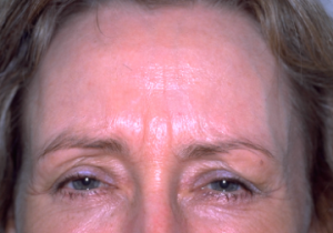 Botox® Before and After Results