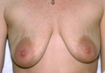 Breast Lift Results Dallas