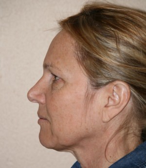 Facelift Before photo (side view) - Dr. Rai
