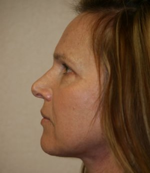 Facelift After photo (side view) - Dr. Rai