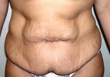 Before picture - Tummy Tuck Vs. Liposuction