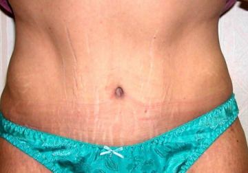 After picture - Tummy Tuck Vs. Liposuction