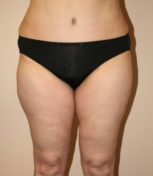Tummy Tuck After Image