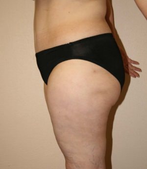 Tummy Tuck After Image