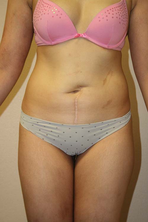 Before picture of a tummy tuck procedure with abdominal scarring