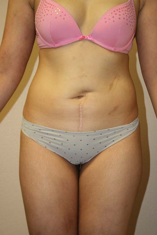 All About Tummy Tuck Scars  Spring Ridge Plastic Surgery