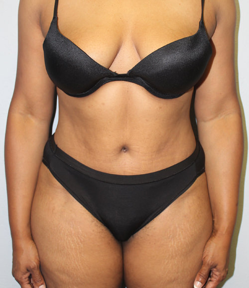 After picture of tummy tuck without abdominal scarring
