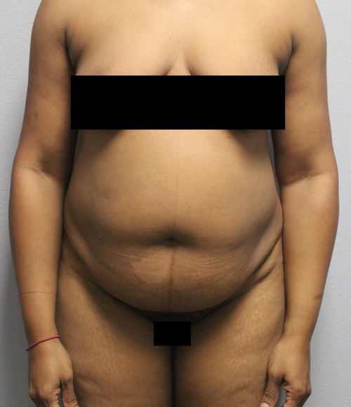 Before picture of tummy tuck with abdominal scarring