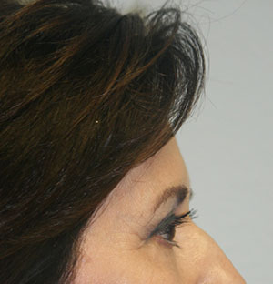 Brow Lift BxA