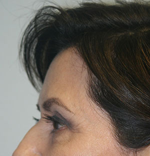 Brow Lift BxA