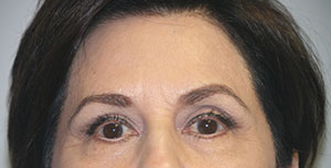 Brow Lift BxA