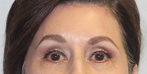 Brow Lift BxA