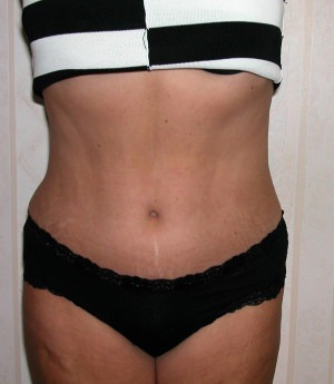 Tummy Tuck Result Dallas