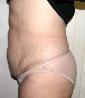 Tummy Tuck Result Dallas