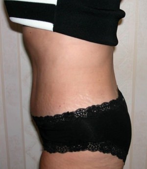 Tummy Tuck Result Dallas