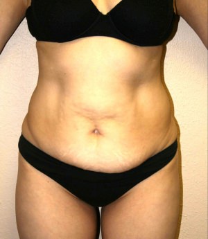 Tummy Tuck Result Dallas