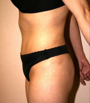 Tummy Tuck Result Dallas
