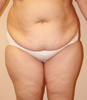 Tummy Tuck Result Dallas