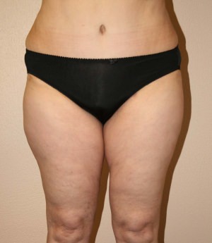 Tummy Tuck Result Dallas