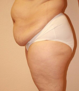 Tummy Tuck Result Dallas