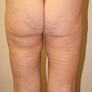 roll of skin at their buttock-thigh junction, Buttock Lift, Dallas TX