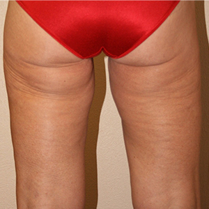Buttock wearing red underwear, Buttock Lift, Dallas TX