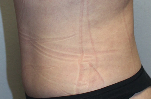 Real Patient Results of Dr. Rai of the Cosmetic Surgical Center in Dallas, TX