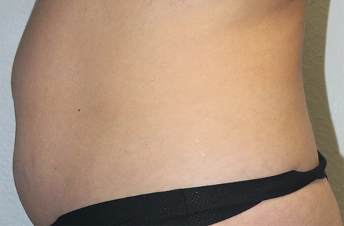 Real Patient Results of Dr. Rai of the Cosmetic Surgical Center in Dallas, TX