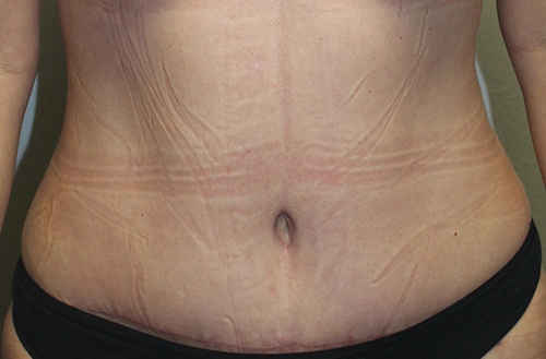 Real Patient Results of Dr. Rai of the Cosmetic Surgical Center in Dallas, TX