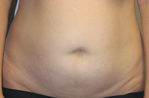 Real Patient Results of Dr. Rai of the Cosmetic Surgical Center in Dallas, TX