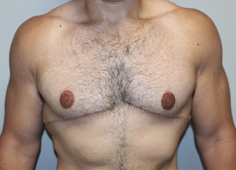 post gyno (2).JPG