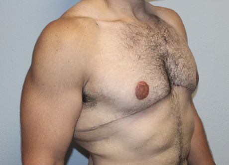 post gyno (3).JPG
