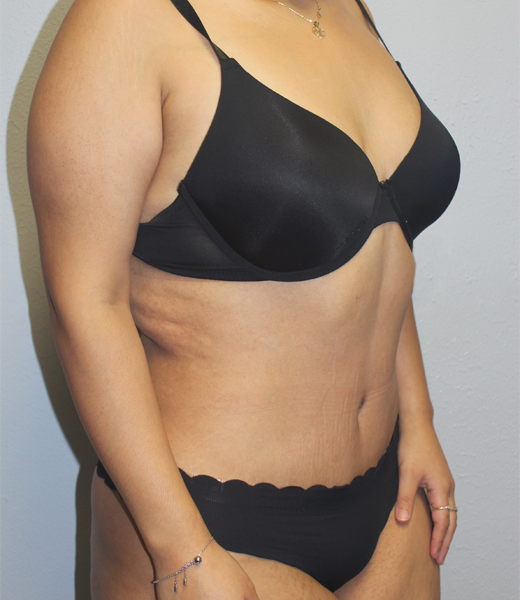 posttummy (1).JPG