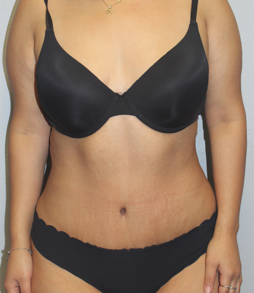 posttummy (2).JPG