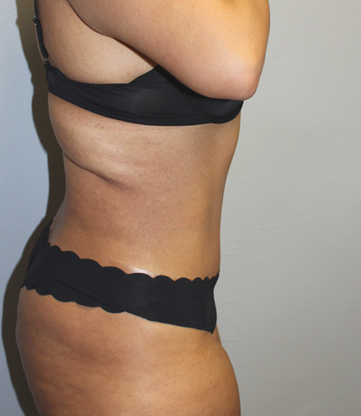 posttummy (3).JPG copy