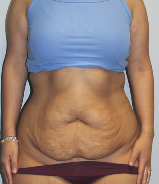 pre tummy (2).JPG